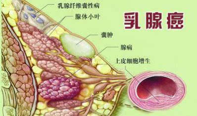 乳腺增生的出现到乳腺癌只有四个阶段