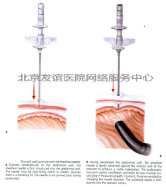 友谊说:经皮内镜下胃造瘘术