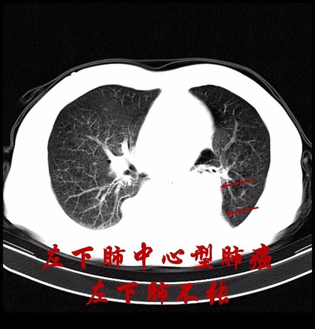 左下肺不张,余肺弥漫性肺气肿.