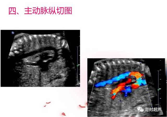 胎儿心脏检查常见切面图