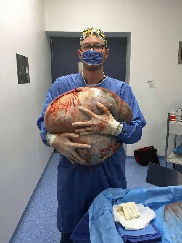 医生切了个"史上最大卵巢囊肿",重达66斤