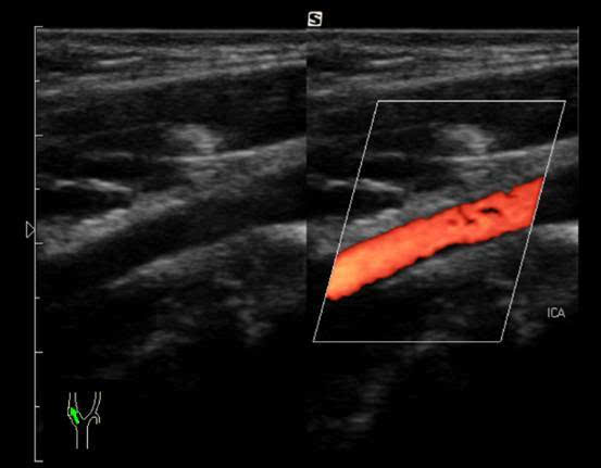 【即时助手】颈动脉超声复习题(二),请收好,不谢!