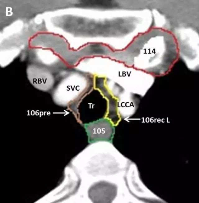 靶区勾画示意图 注:106pre(气管前淋巴结)位于胸段气管前壁前面
