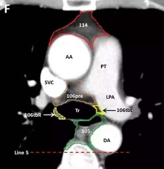 手把手教你:食管癌纵隔淋巴结 ct 分区及靶区勾画