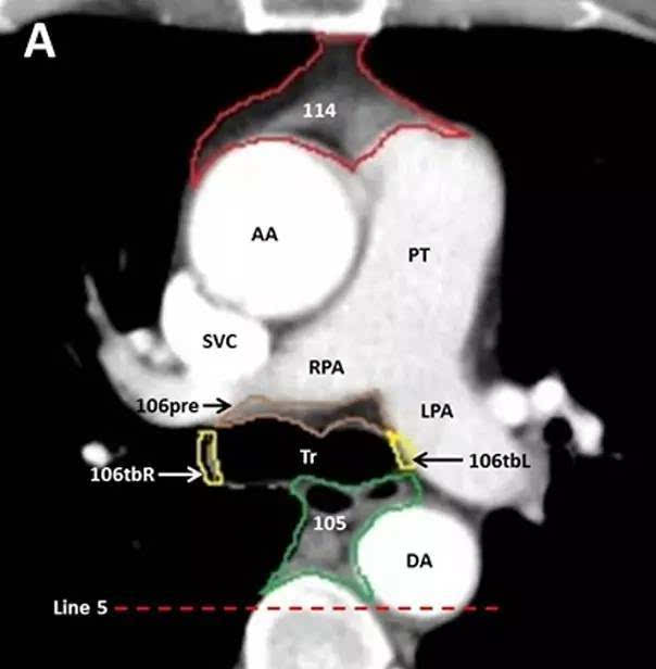 手把手教你:食管癌纵隔淋巴结 ct 分区及靶区勾画