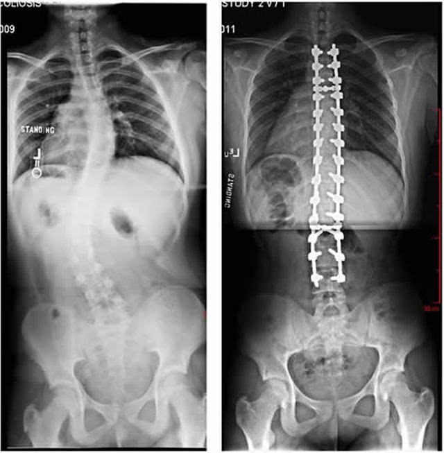 脊柱侧弯,最应该知道的那些事!