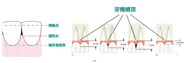 当接触点到牙槽嵴顶的垂