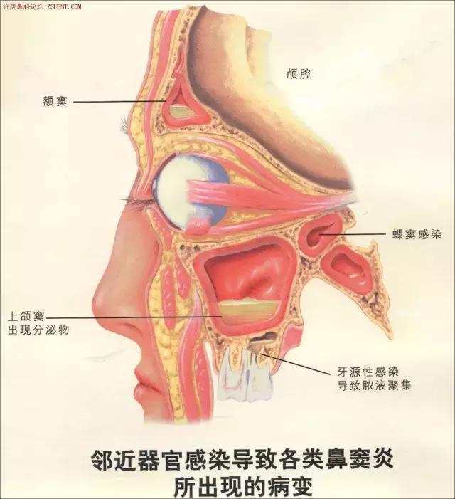 免疫功能缺陷,腺样体肥大等邻近组织器官病变,窦口鼻道复合体解剖结构