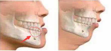而嘴巴两侧的突出,则是红圈位置的牙齿牙槽骨突出所致.