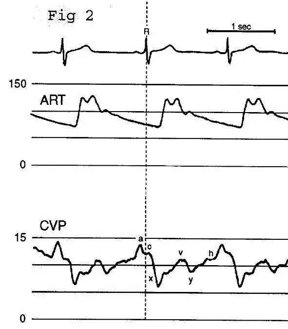 cvp波形对诊断的作用 房颤:a波消失;c波明显(舒张末期和收缩早期,心