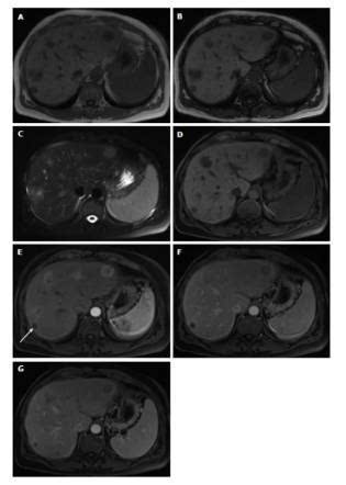 快速入门手册 肝脏占位mri