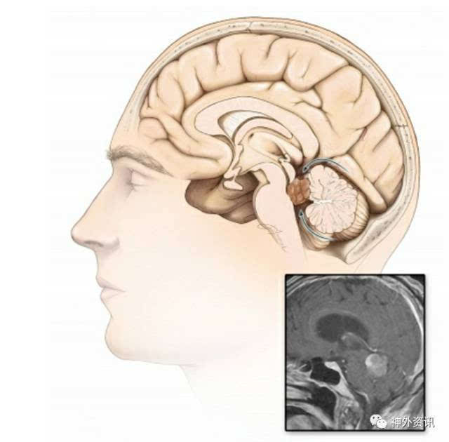 松果体区病变的手术入路选择| the neurosurgical atlas全文翻译