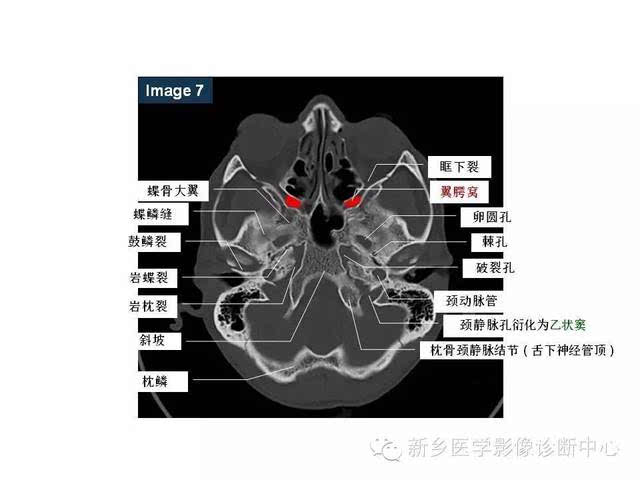 鼻咽部的详细解剖(含各个孔道)