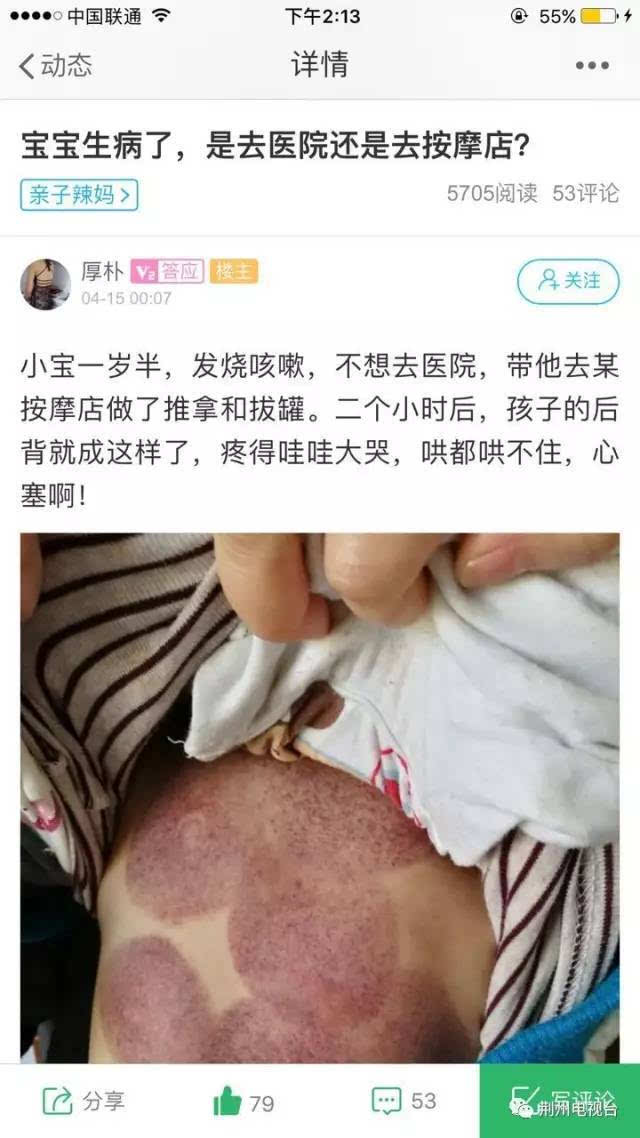 带一岁多的孩子推拿和拔罐,结果孩子疼的哇哇大哭,后背变成了这样