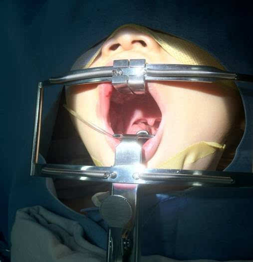 常规做喉罩下的小儿扁桃体-腺样体切除术麻醉,但在院外的手术室交流中