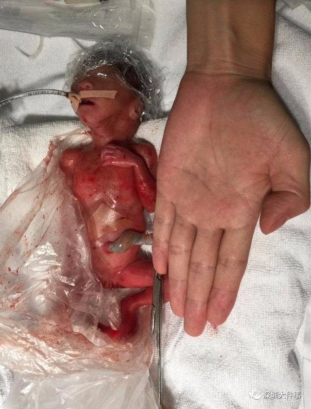 胎龄23周,体重不足1斤的早产宝宝竟然活了下来!