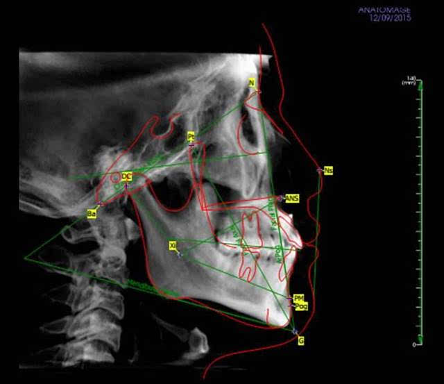 头侧位片显示患者牙合型为安氏Ⅱ类,轻度骨性Ⅲ类,上前牙唇倾,均角.