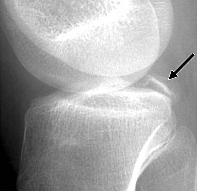 图8a -17岁男孩,后交叉韧带(pcl)撕脱性骨折.