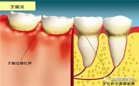 牙龈炎与牙周炎