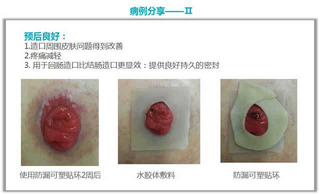 第二届康乐保护理高峰论坛前沿分享Ⅷ——造口护理中防漏可塑贴环的