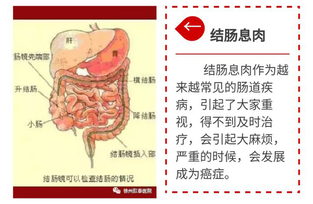 徐州肛泰中医院:了解结肠息肉危害,更好合理保健