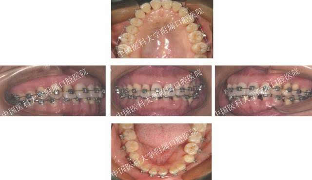 【广泛型侵袭性牙周炎】牙周联合正畸治疗病例一例