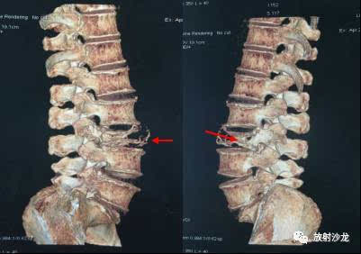 单个椎体病变,你诊断对了吗?