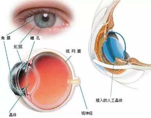 医学定义:透明晶状体发生混浊(就像相机的镜头出了故障,不能形成清晰