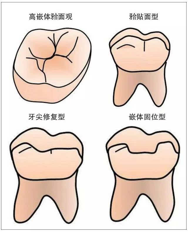 高嵌体牙合面观及各种牙体缺损类型的高嵌体