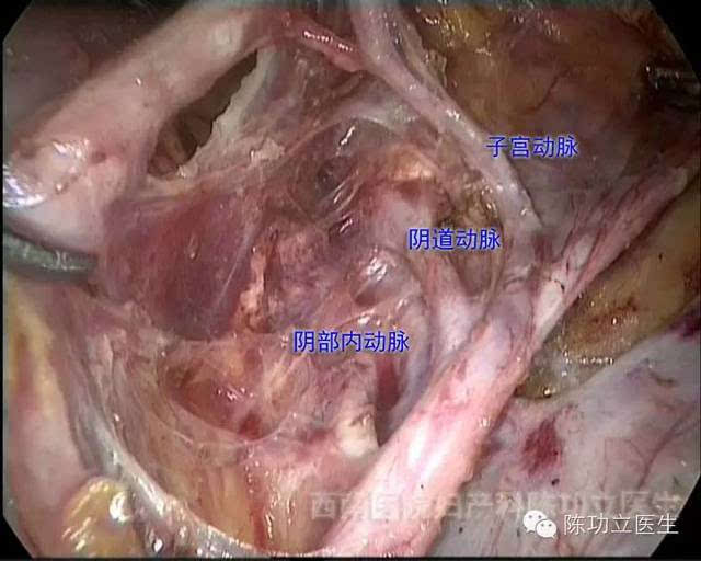 旋髂深静脉容易被损伤,如损伤在远静脉端,可以电凝,如果在靠近髂外