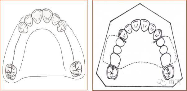 可摘局部义齿的肯氏(kennedy)分类及设计