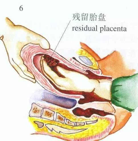 宫缩乏力导致胎盘不能自行脱落或者是残留了一部分在体内