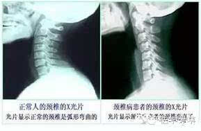 第七颈椎横突有无过长,有无颈肋.钩锥关节及椎间隙有无增宽或变窄.