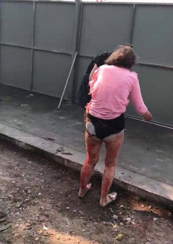 一女子因爆炸原因炸的浑身是血 只剩下一条内裤