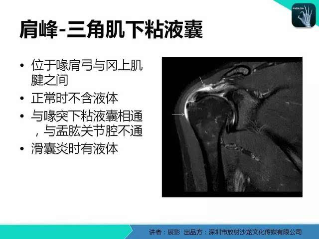 【专家大讲堂】肩峰下撞击综合征和 肩袖损伤的mr表现