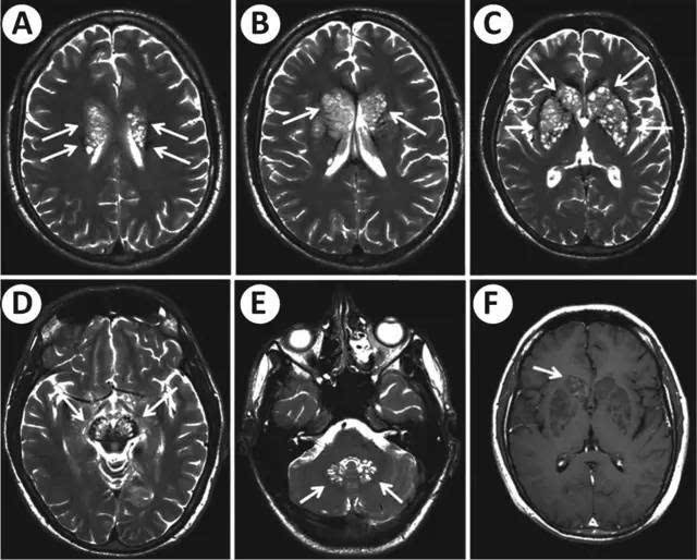 【经典分析】颅内隐球菌感染的影像学表现