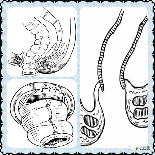 一般于结肠内置入小儿麻醉螺旋导管作支架,拖出肛门结肠浆肌层与肛管