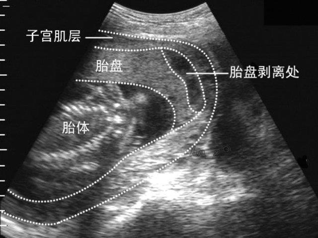 什么是胎盘早剥,要注意什么?