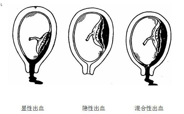 什么是胎盘早剥,要注意什么?