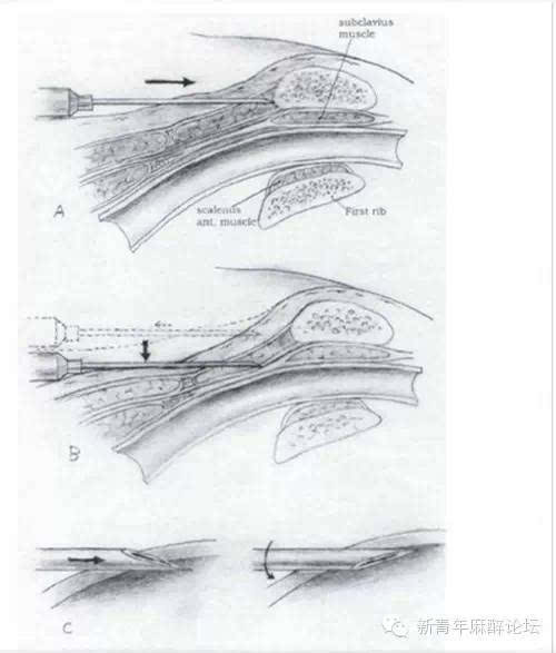 史上最详细的锁骨下静脉穿刺技巧总结赶紧收藏了