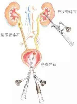 卫中庆主任为其检查后明确为右侧输尿管结石伴右肾积水,右肾下盏结石