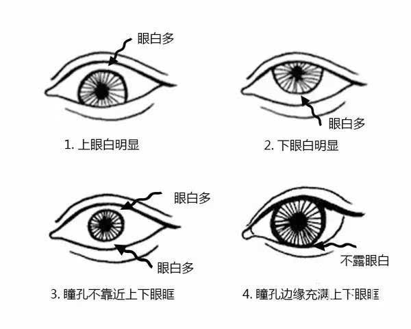 由于白眼球占得比例较大,如果上眼皮弧度又比较平缓,一眼望去满目