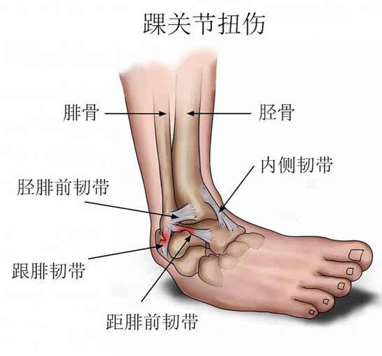 踝关节外侧韧带损伤约占踝关节扭伤的85%.