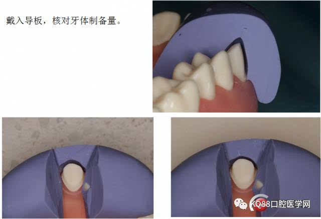 左上尖牙牙体预备