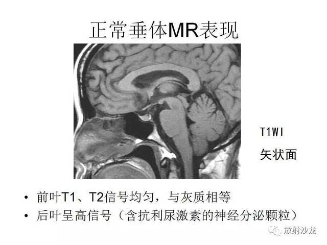 垂体瘤的mr诊断与鉴别诊断