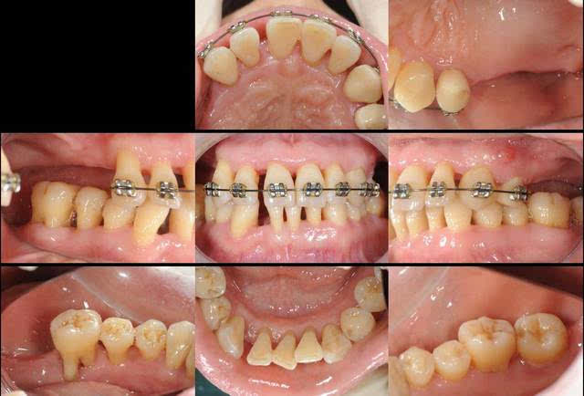 2013年3月,上颌牙齿正畸加力过程中