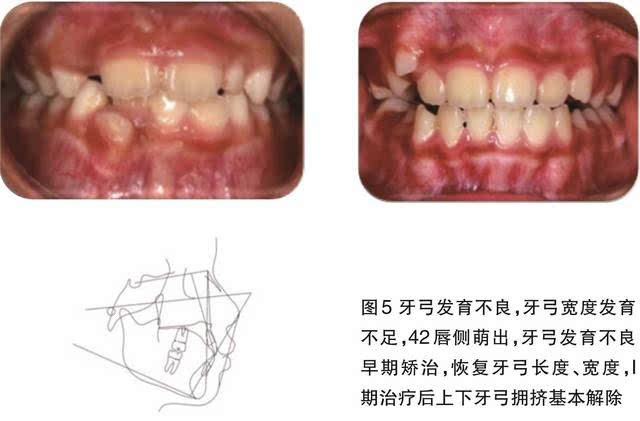 混合牙列早期上下牙弓/牙槽骨弓发育异常:上牙弓狭窄,下牙弓形 态