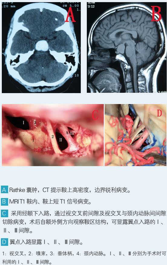 继之,用于 2,颞枕开颅与乙状窦前入路 颅底外科专业化以后,乙状窦前