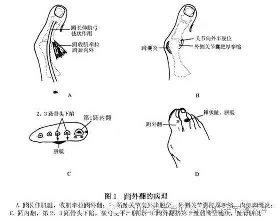 关节常是匹配的,畸形可能由趾间拇外翻引起.