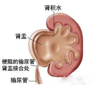 肾结石为什么会引起肾积水?该如何处理呢?